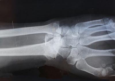 Growing new bone for more effective injury repairREAD MORE